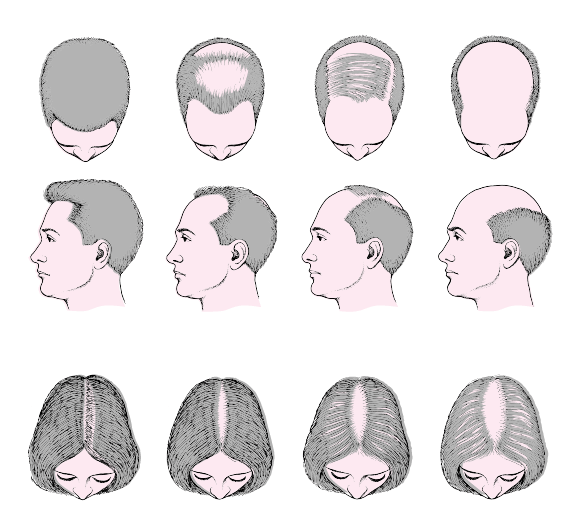 Haaruitval Androgenetica alopecia